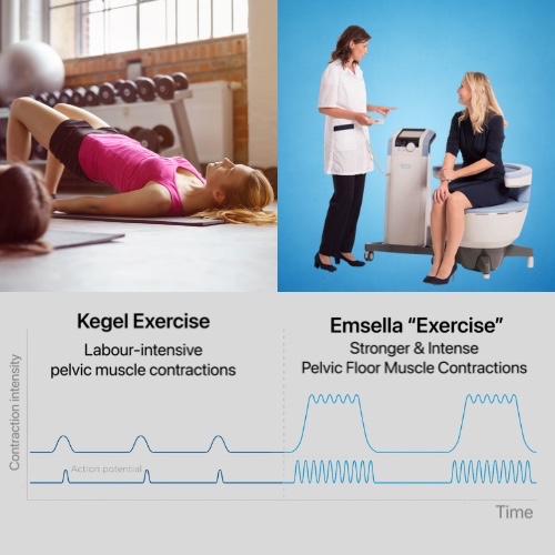 Emsella with B&Co. | the safest solution for urinary incontinence and ...