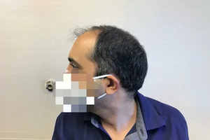 Before Treatment
