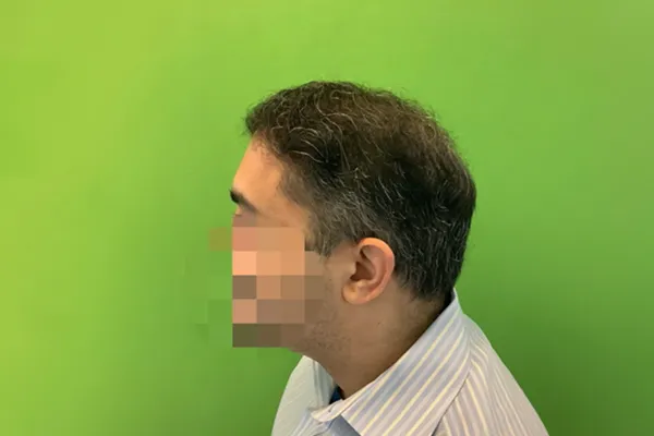 After Treatment