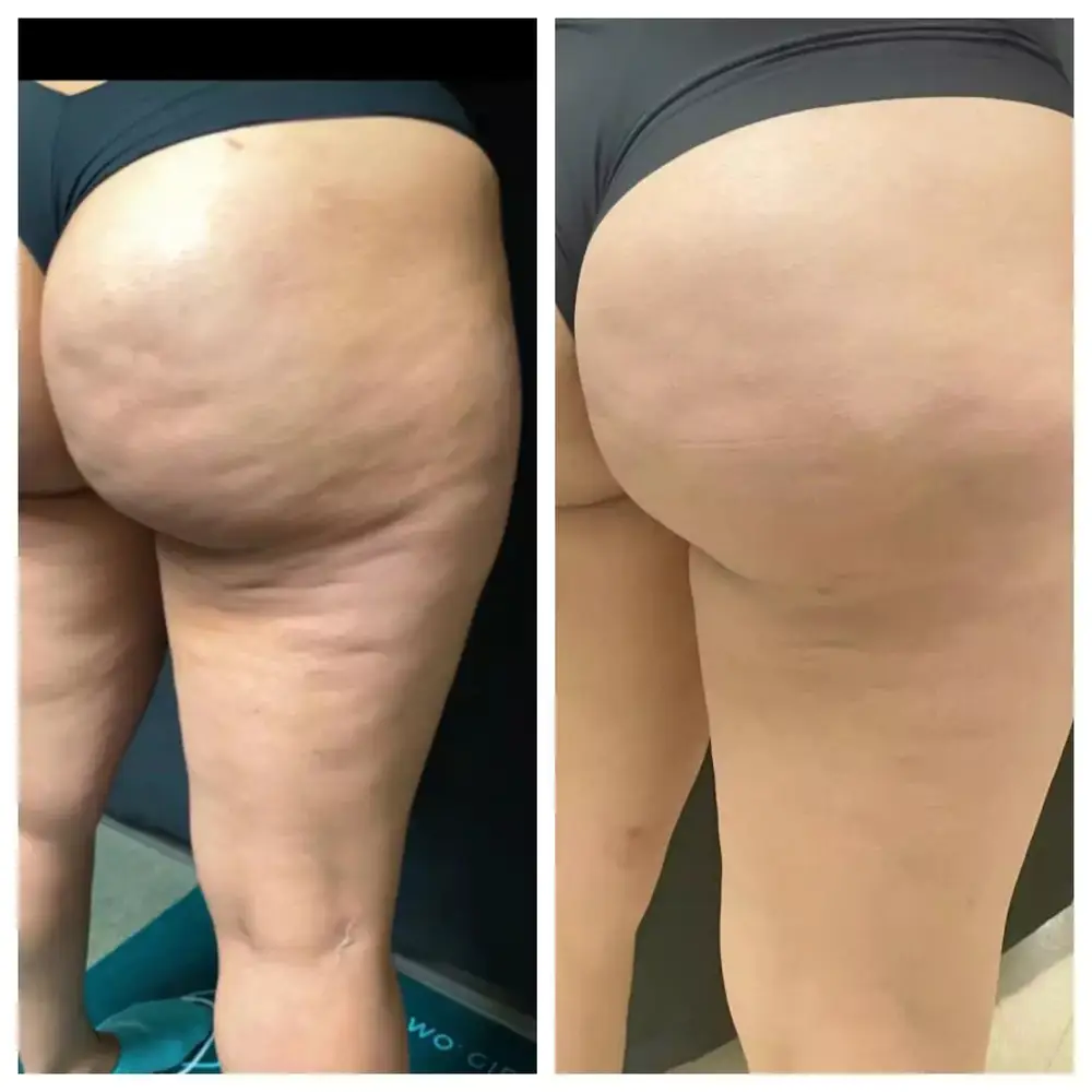 Cellulite results, back of thigh