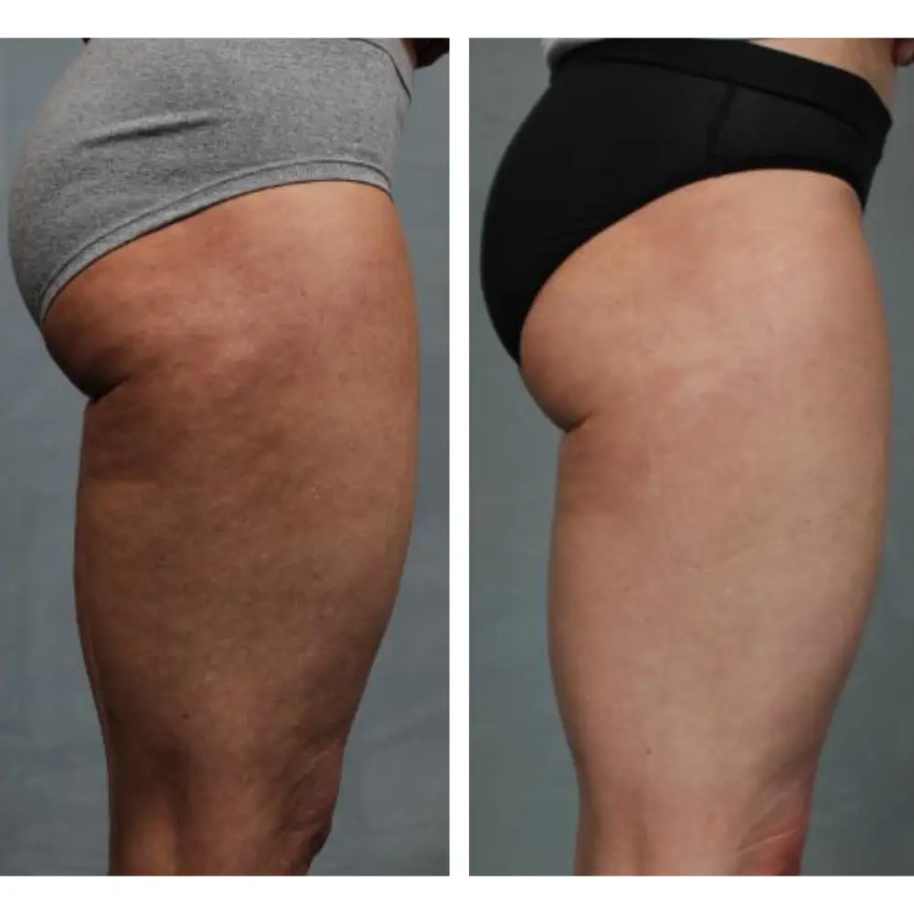 Cellulite results, side of thigh