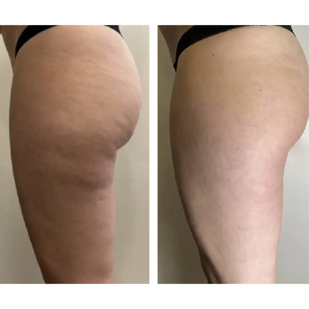 Cellulite results, thigh