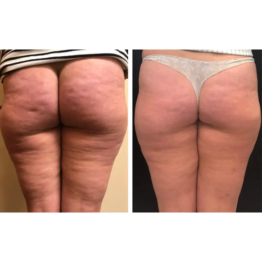 Cellulite results, buttocks