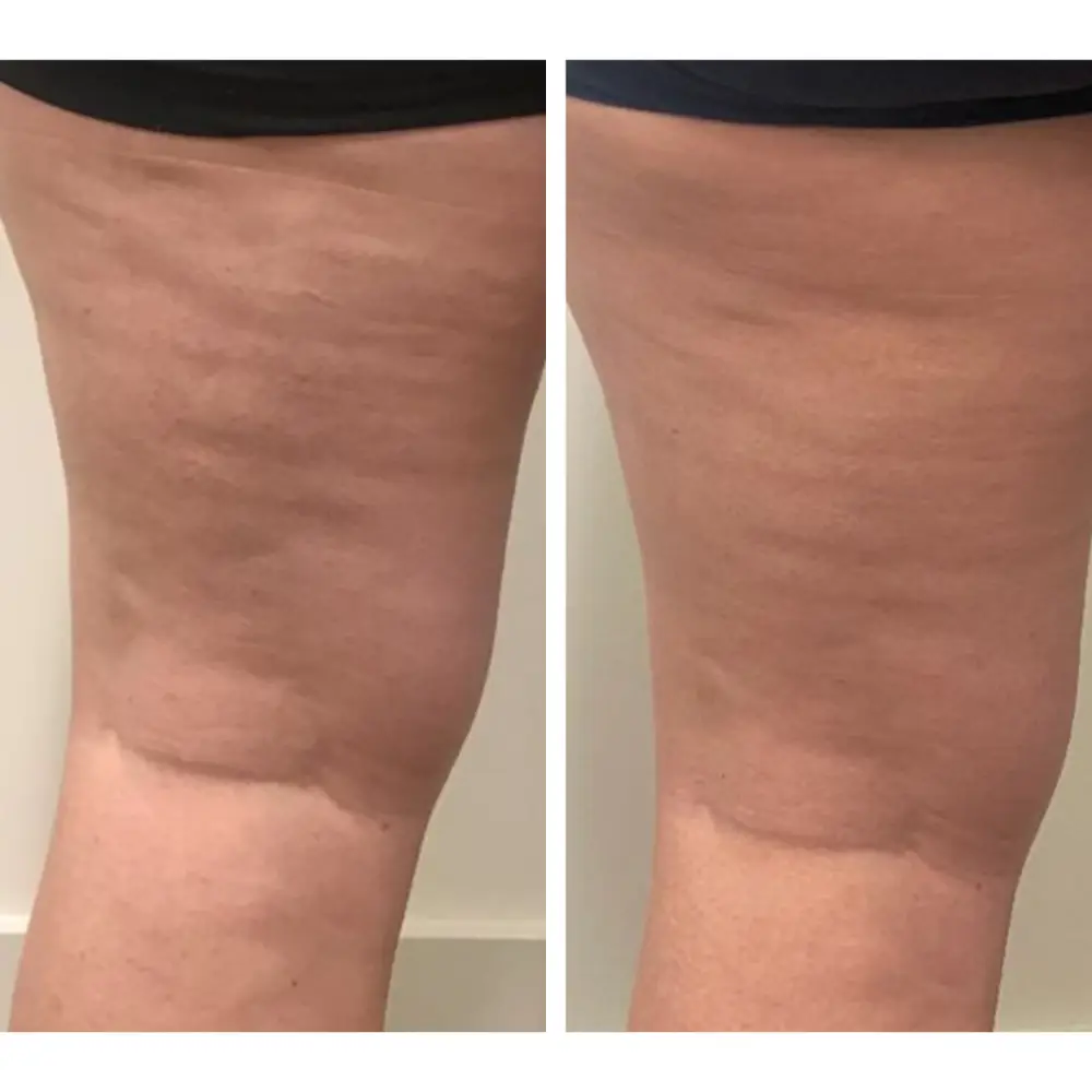 Cellulite results, thighs