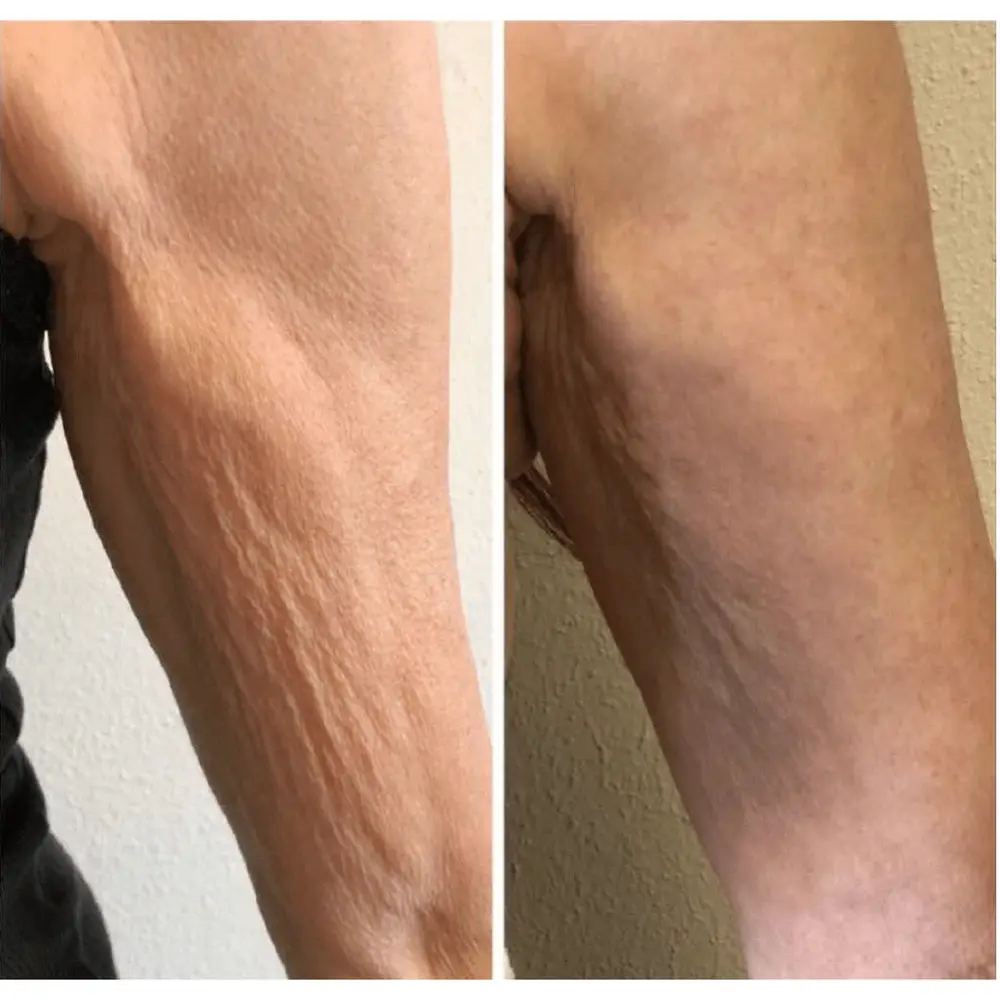 Skin texture results, arm