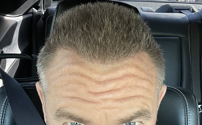 After Treatment