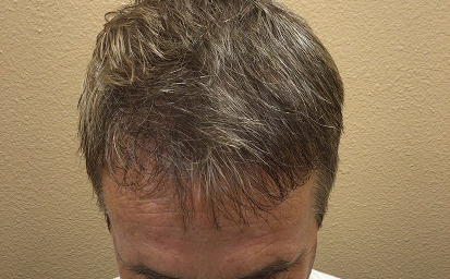 After Treatment