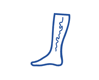 Varicose Veins