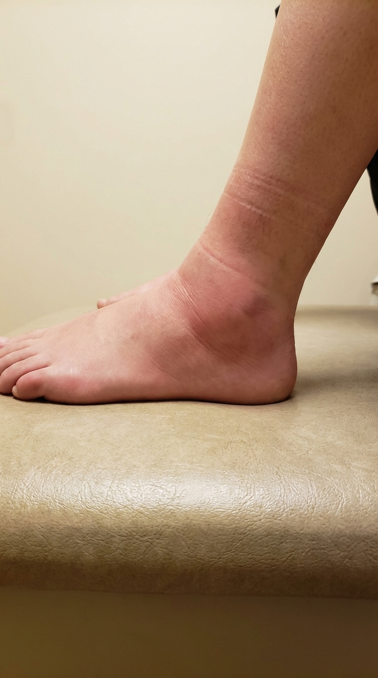 Swollen Ankles