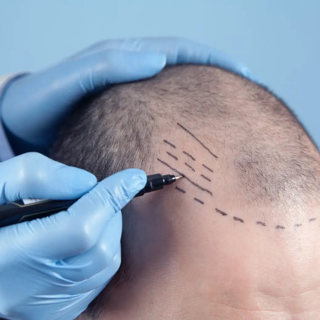 Hair Transplant