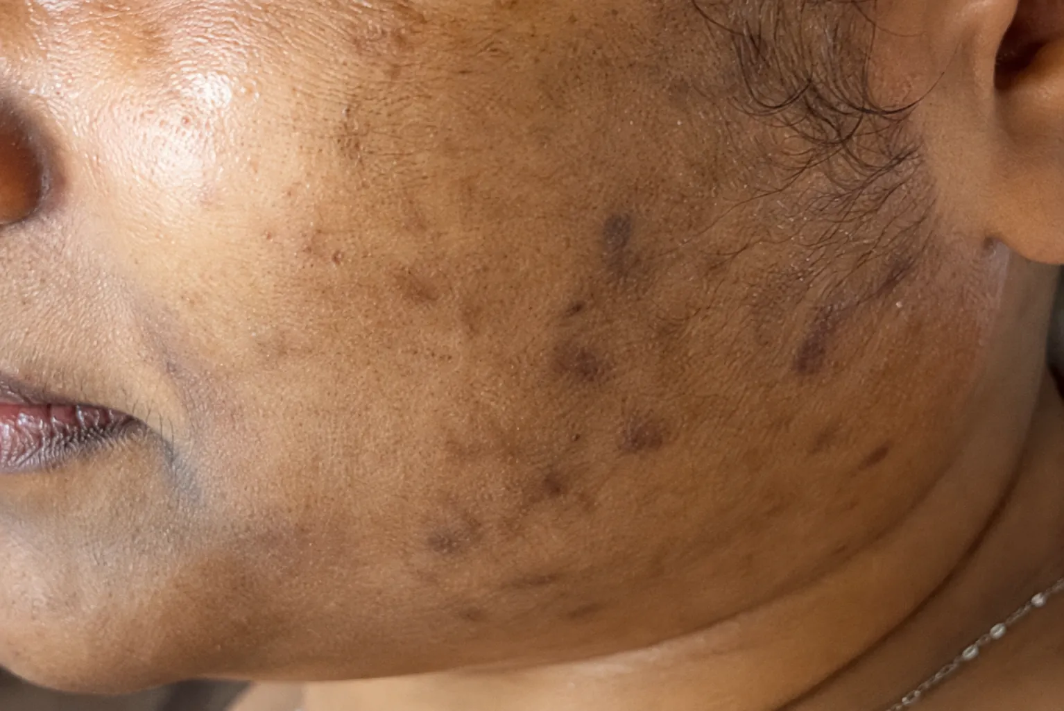 Before treatment: sun-induced pigmentation across the cheeks