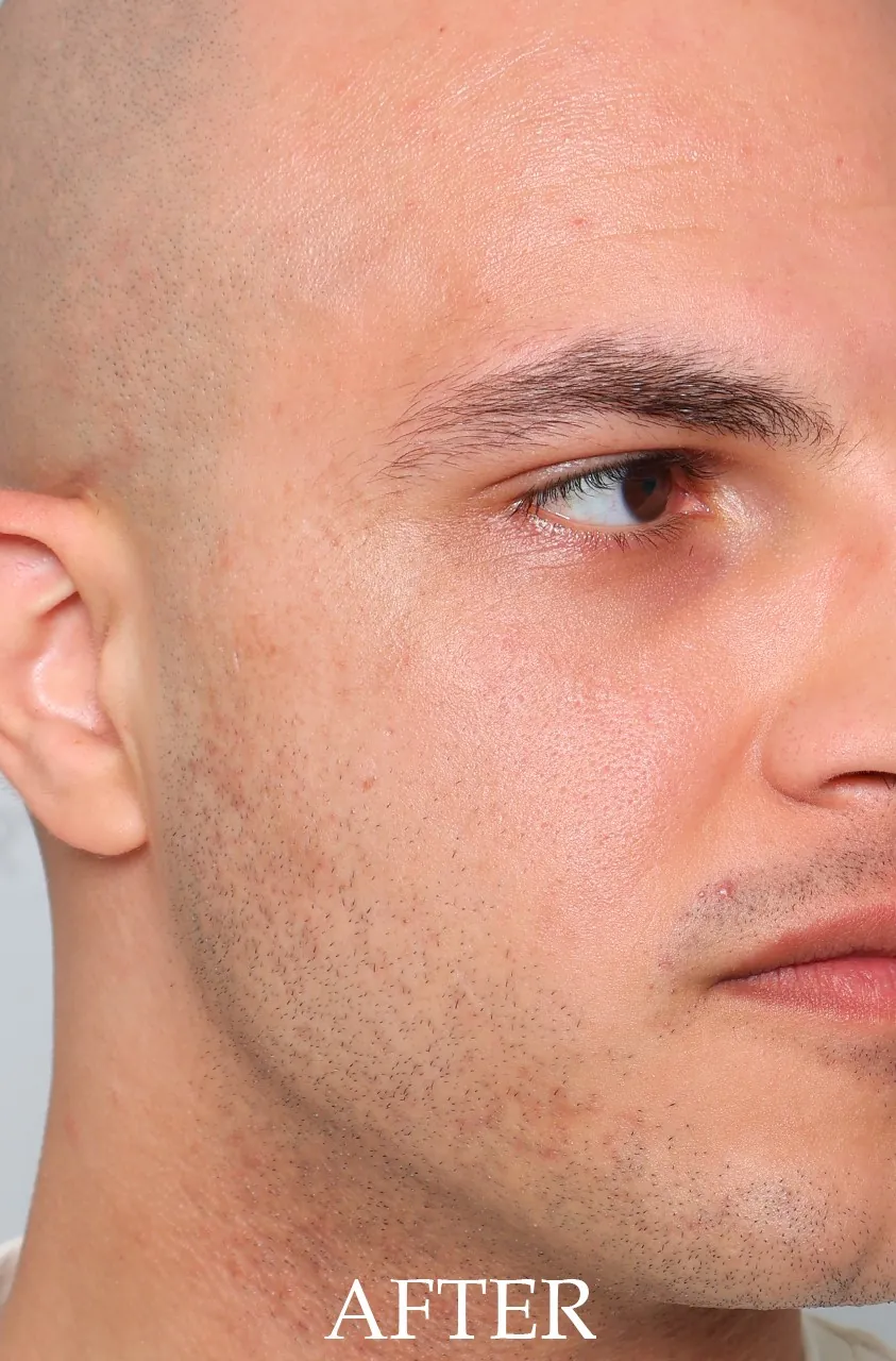 After the full AFT protocol: pigmentation across the cheeks and upper lip visibly reduced
