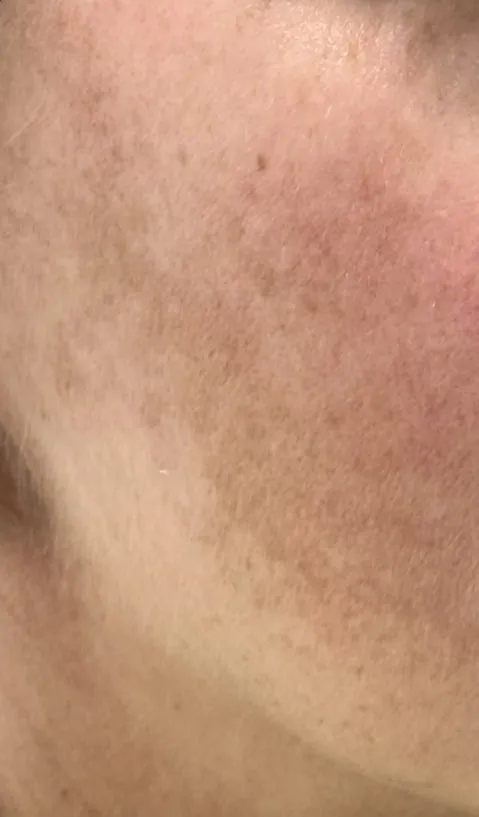 Before treatment: accumulated sun damage and freckling