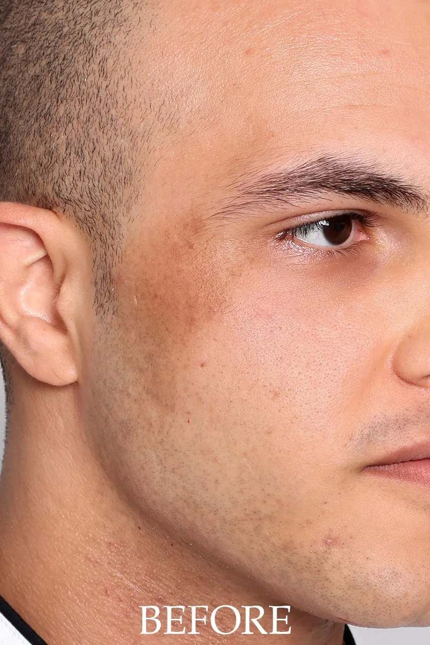 Before treatment: pigmentation across the cheeks and upper lip