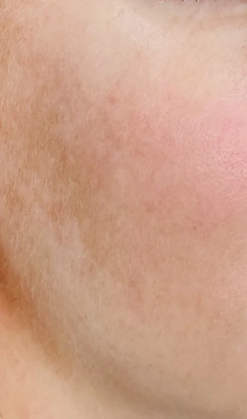 After the full AFT protocol: accumulated sun damage and freckling visibly reduced
