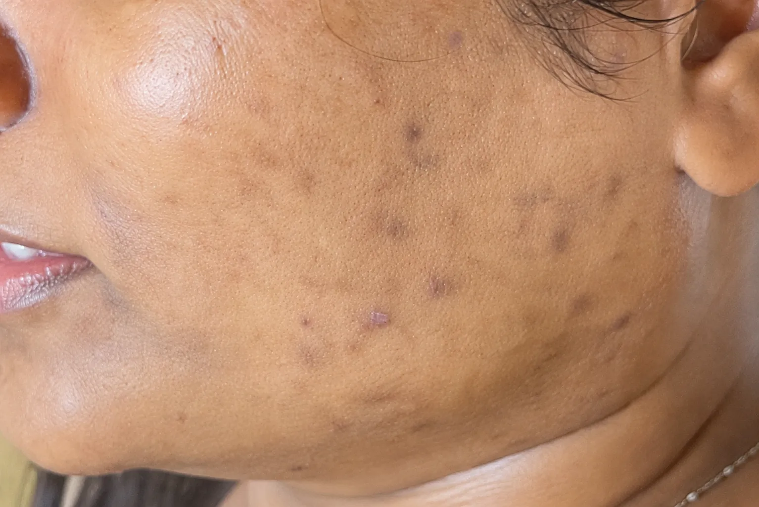 After the full AFT protocol: sun-induced pigmentation across the cheeks visibly reduced