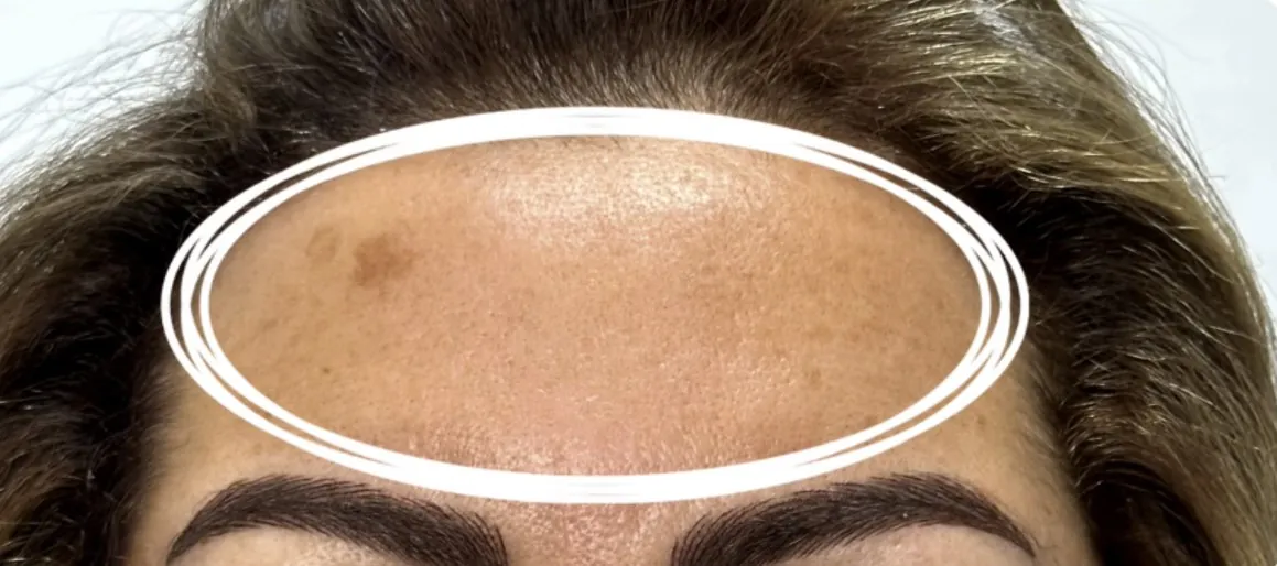 Before treatment: flat brown age spots