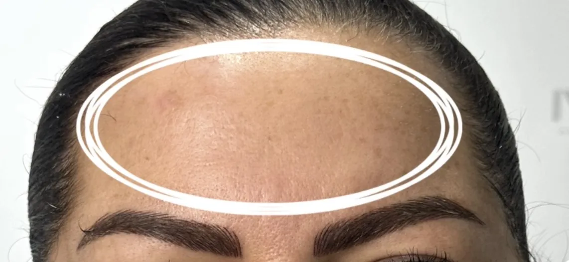 After the full AFT protocol: flat brown age spots visibly reduced
