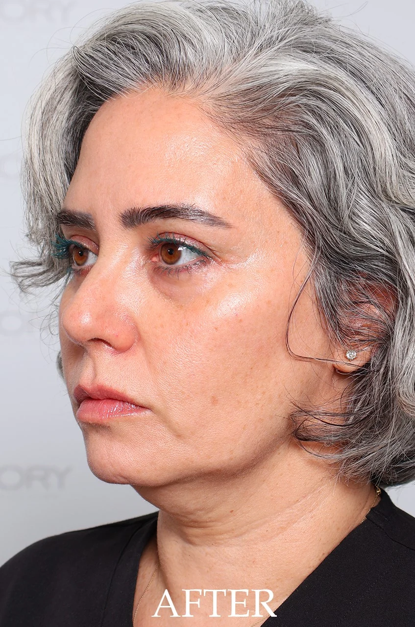 After the full AFT protocol: uneven, dull skin tone visibly reduced