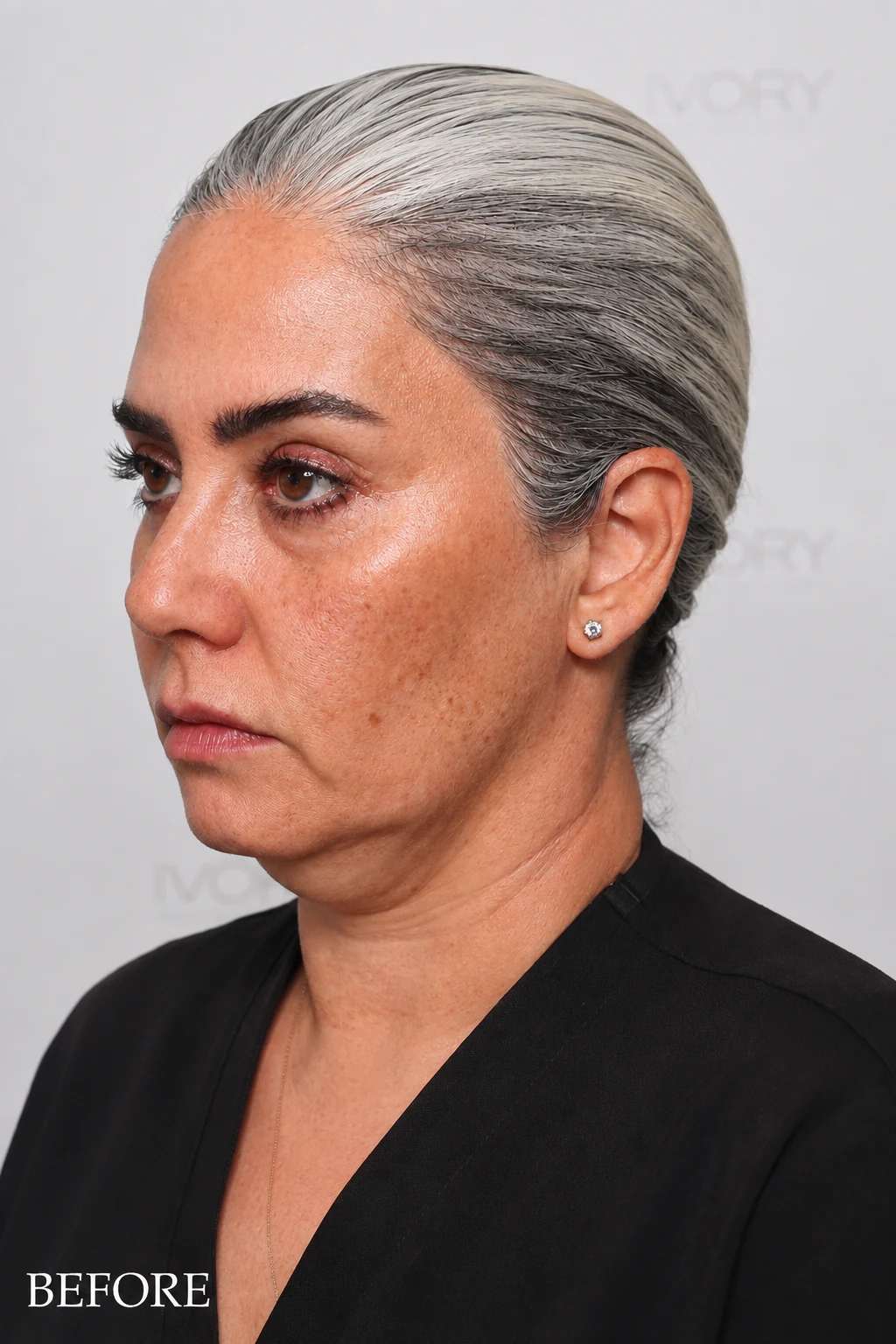 Before treatment: uneven, dull skin tone