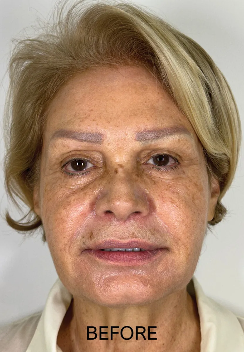 Before treatment: facial redness and visible capillaries