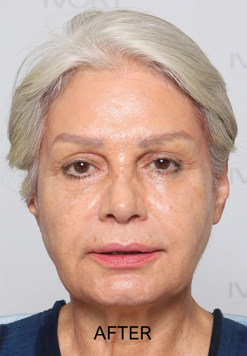 After the full AFT protocol: facial redness and visible capillaries visibly reduced